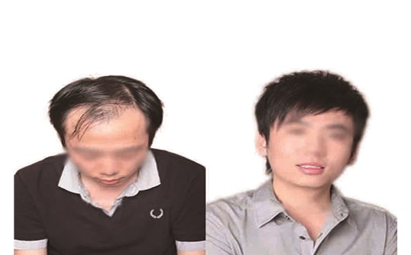想了解為啥經(jīng)常脫發(fā)嗎？南陽(yáng)頂美帶你避掉這些坑！