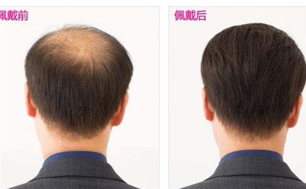 傳統男士發(fā)套早已過(guò)時(shí) 廉價(jià)低端假發(fā)戴不出好形象!