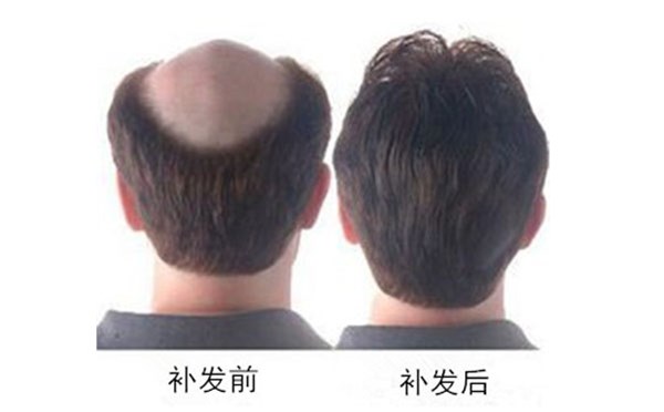 跑步的時(shí)候，佩戴的發(fā)際線(xiàn)補發(fā)會(huì )不會(huì )掉呢？