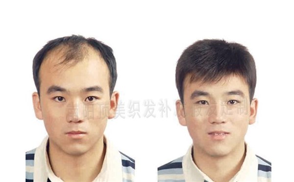 日常保養假發(fā)時(shí)，應注意哪些事項呢
